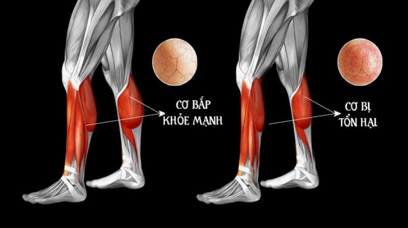 Caffein có thể gây tiêu cơ vân